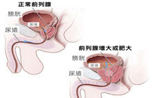 赤峰林西县医院：前列腺肥大需要